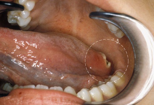 10 bệnh thường gặp ở miệng: Cái số 5 và 6 có thể biến thành ung thư, ai cũng nên cảnh giác - Ảnh 8. 10 bệnh thường gặp ở miệng: Cái số 5 và 6 có thể biến thành ung thư, ai cũng nên cảnh giác - Ảnh 8.