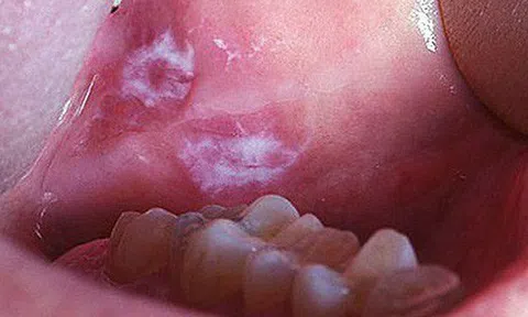 10 bệnh thường gặp ở miệng: Cái số 5 và 6 có thể biến thành ung thư, ai cũng nên cảnh giác