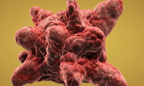 10 chất gây ung thư phổ biến mà bạn nên biết: Có nhiều thứ chúng ta tiếp xúc thường xuyên