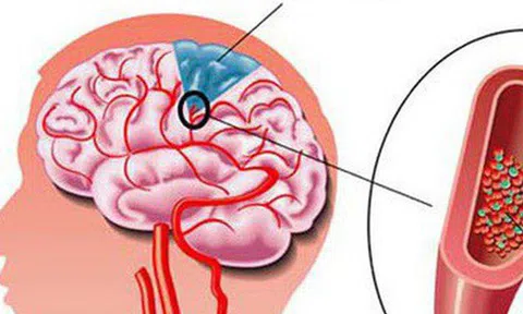 Đau đầu, chóng mặt: Dấu hiệu cảnh báo căn bệnh nguy hiểm không nên bỏ qua