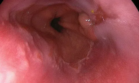 Chỉ cần thấy 1 trong 4 dấu hiệu này lặp lại 2 tuần: Bạn nên đi khám ung thư thực quản gấp