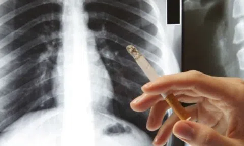 90% người mắc ung thư phổi tử vong trong vòng 1 đến 2 năm vì bỏ qua những dấu hiệu này